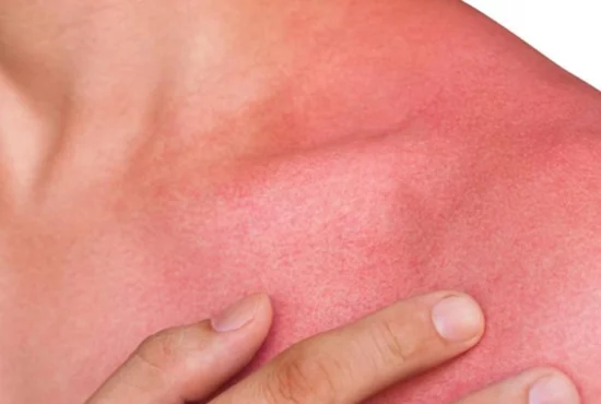 ۱۰ عامل که سبب قرمزی پوست می شود و راه های درمان آن ها